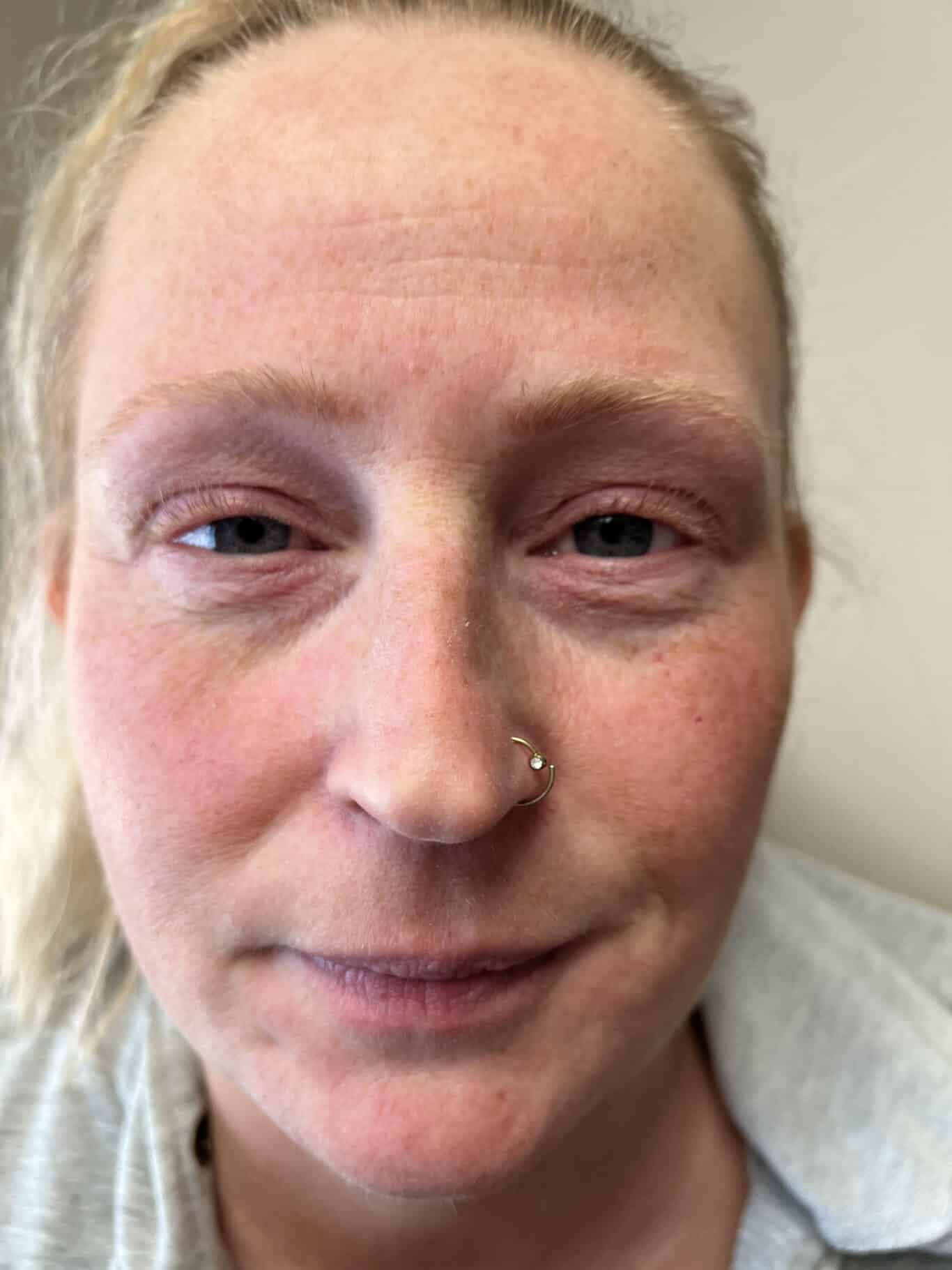 Lip Filler Treatments in Vancouver