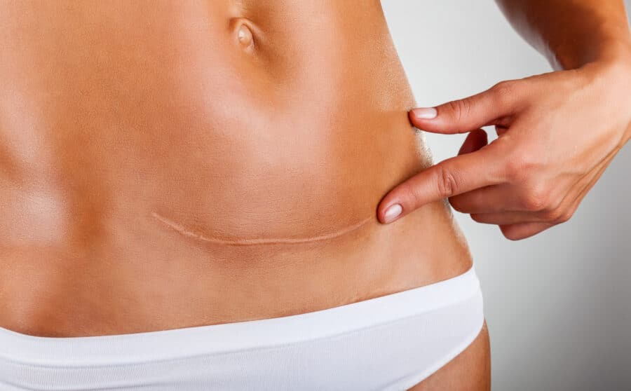 c-section scars can be reduced through scar removal surgery